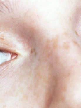 How To Choose The Right Concealer To Banish Dark Circles Hero